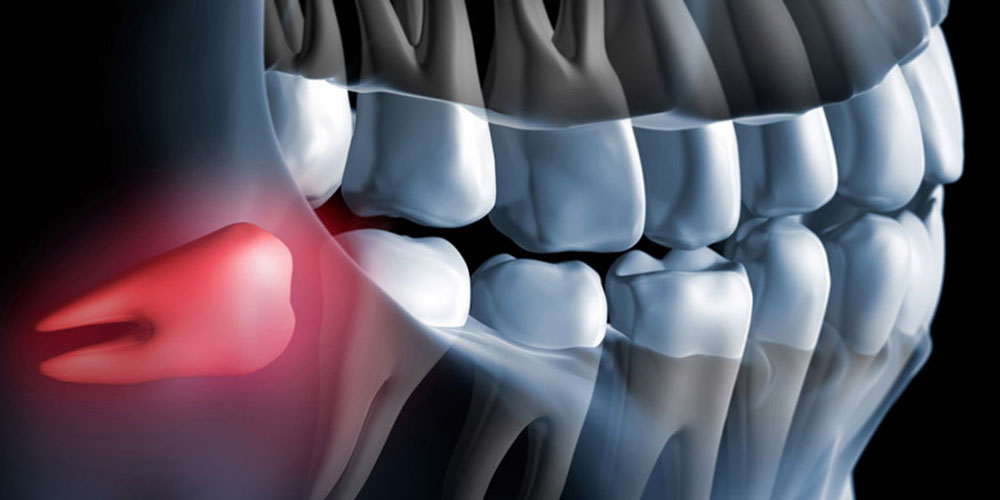 Stichwort Weisheitszähne 