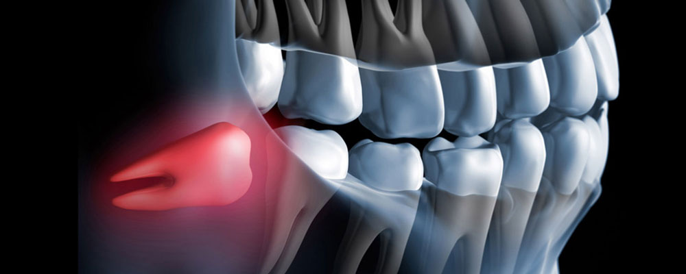 Stichwort Weisheitszähne 