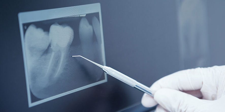 Geschädigter Zahn: Wurzelbehandlung oder Implantat?