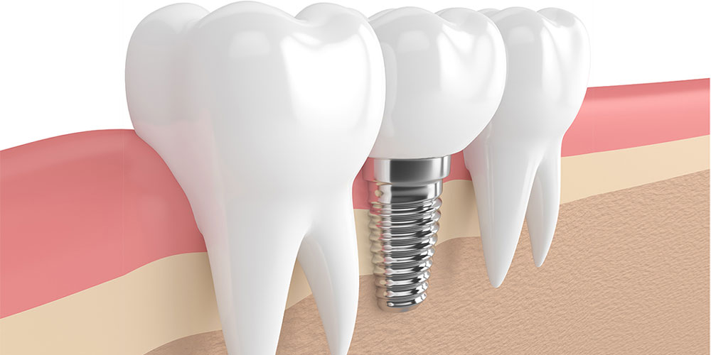 Krankheitsbedingte Zahnlosigkeit: Anspruch auf Implantate!