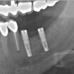 3D-Implantatdiagnostik