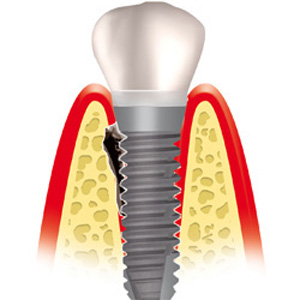 Periimplantitis