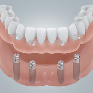 Titan oder Keramik: Welches ist das bessere Implantat?