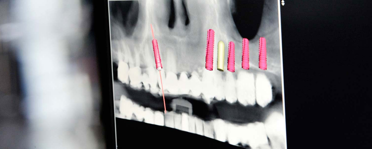 3D-Implantatdiagnostik