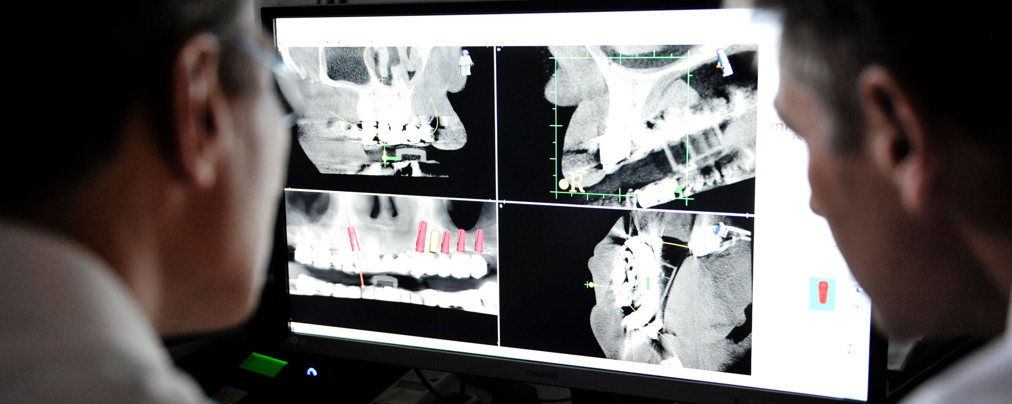 Implantate: festsitzende Zähne nach Sofortimplantation